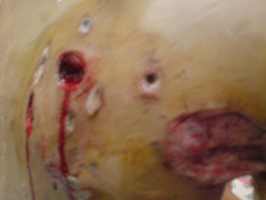 Chemical burns follwong Israeli bombings by ISM Palestine